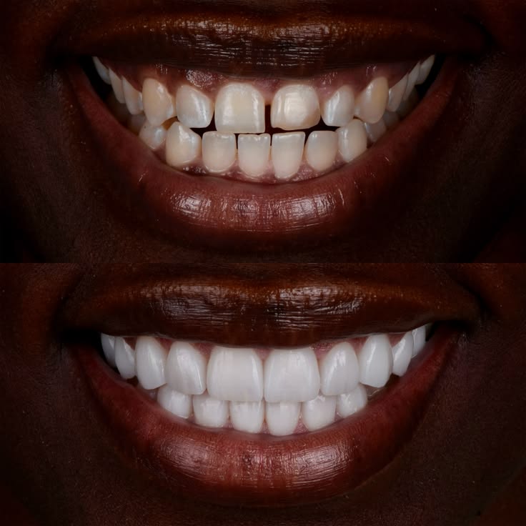 Gallery_ Before and After Dental Veneers in Los Angeles, CA _ Smiles By Dr_ P